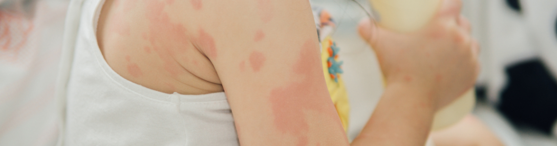 Children with Eczema: Causes, Symptoms, Triggers & How to Treat it