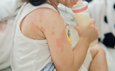 Children with Eczema: Causes, Symptoms, Triggers & How to Treat it