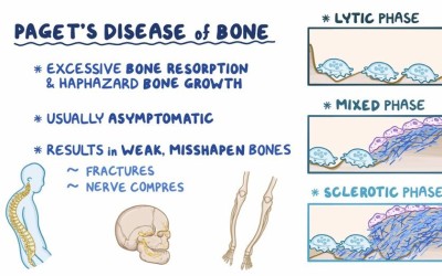 What Is Pagets Disease Of Bone?